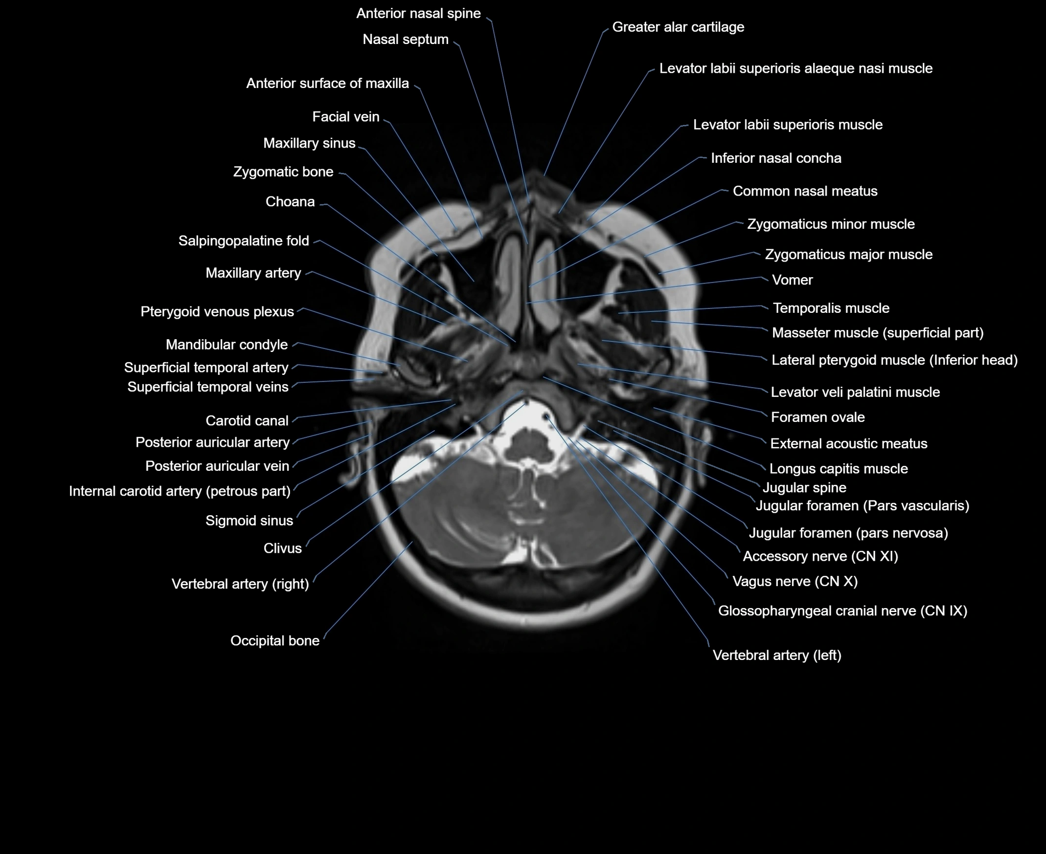 MRI Neck 3D labelled cross section anatomy axial 3t image-00001-00013.webp